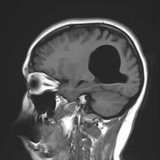 Brain Cyst